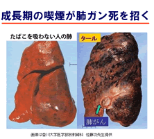 成長期の喫煙が肺がん死を招く