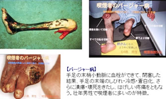 たばこによる健康被害